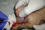 lane-implant-removal-4
